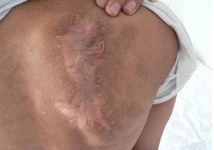 得了血管瘤有哪些治療方法