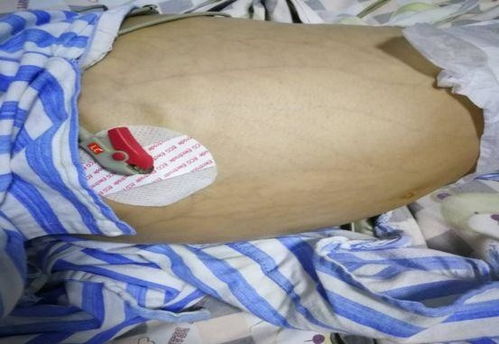 胃腸減壓方法有哪些