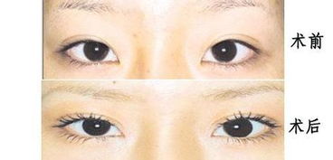 開眼角手術后怎樣護理方法有哪些