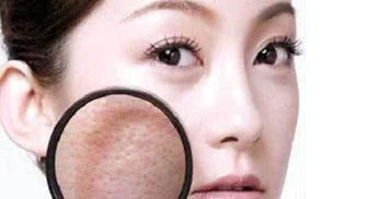 醫(yī)美治療毛孔粗大有哪些方法