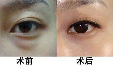 眼袋手術檢查哪些方法