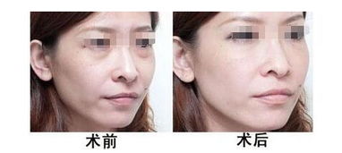 怎么有效的去眼袋的方法有哪些問題