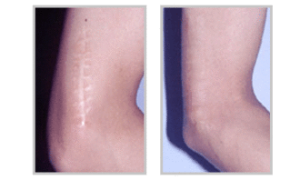 有什么好的去疤方法有哪些