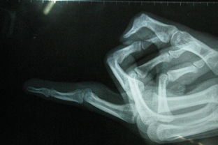 手關(guān)節(jié)軟組織挫傷怎么處理？(軟組織挫傷多久能好？)