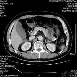 注意事項(xiàng),觀察,腦水腫