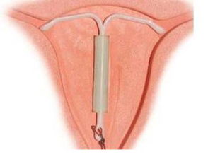 女人上環(huán)后需要注意些什么,帶環(huán)后注意什么,帶環(huán)后注意事項(xiàng)及飲食