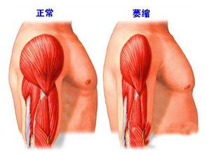 肌肉,手法,注意事項,按摩