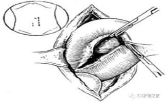 小腸造瘺術(shù)后注意事項(xiàng),結(jié)腸造瘺術(shù)后注意事項(xiàng),膀胱造瘺術(shù)后注意事項(xiàng)