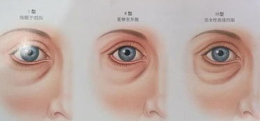 做眼袋注意事項(xiàng),割眼袋術(shù)后注意事項(xiàng),割完眼袋注意事項(xiàng)