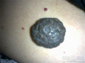 黑色素瘤飲食注意事項(xiàng),黑色素瘤術(shù)后注意事項(xiàng),懷疑黑色素瘤活檢注意事項(xiàng)