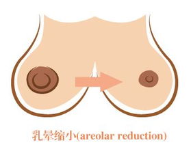 做乳暈變小手術(shù)注意事項,乳暈注射注意事項,激光乳暈?zāi)奂t術(shù)注意事項