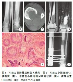 脛骨造釉細胞瘤飲食注意事項