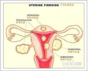 孕婦有子宮肌瘤飲食注意事項(xiàng),子宮肌瘤和卵巢囊腫飲食注意事項(xiàng),子宮肌瘤手術(shù)后飲食注意事項(xiàng)