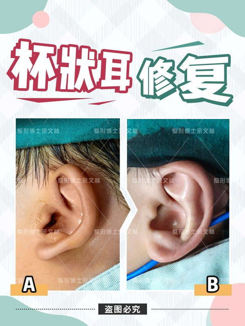 杯狀耳手術(shù)的注意事項(xiàng)