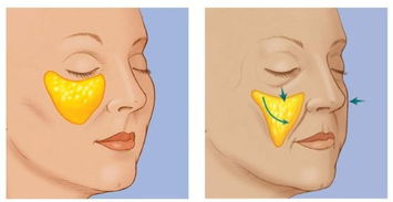 肌注,打了,事項(xiàng),蘋果