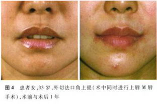 做完唇后應注意事項