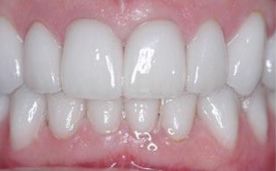 注意事項(xiàng),烤瓷牙