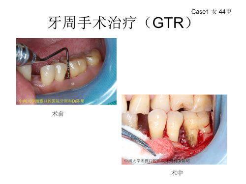 牙周翻瓣術(shù)的注意事項(xiàng),牙周翻瓣術(shù)術(shù)后注意事項(xiàng),牙周翻瓣術(shù)