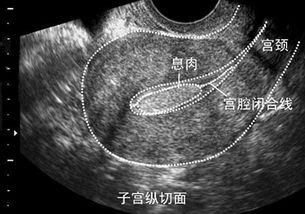 刮息肉后注意事項