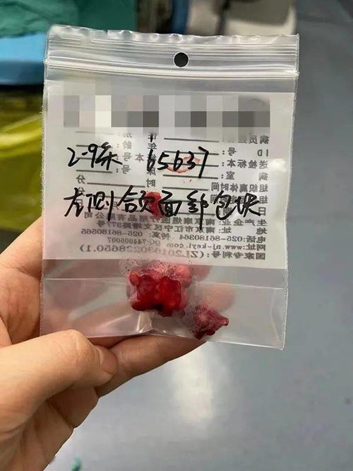 腮腺瘤術(shù)中注意事項