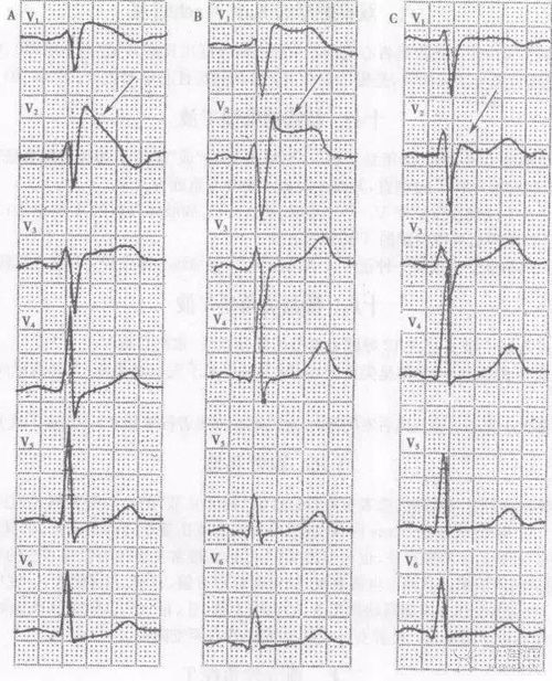 描記心電圖時的注意事項