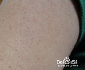 腿上雞皮疙瘩注意事項(xiàng)