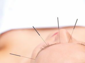 扎針拔罐注意事項