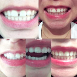 戴牙套需要注意事項(xiàng)