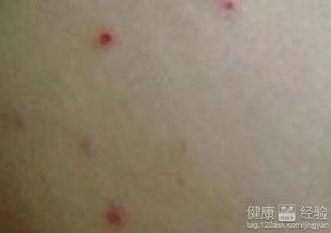 疹子,注意事項(xiàng),寶寶