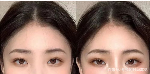 眉骨開(kāi)裂注意事項(xiàng)