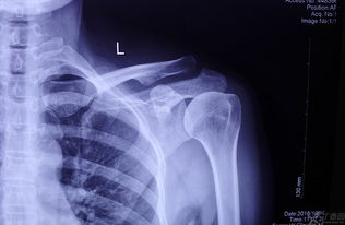 肩鎖關(guān)節(jié)脫位保守治療及注意事項(xiàng)