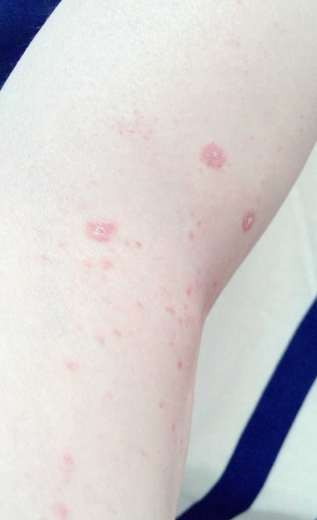 得了玫瑰糠疹注意什么,玫瑰糠疹注意事項(xiàng),玫瑰種植方法和注意事項(xiàng)