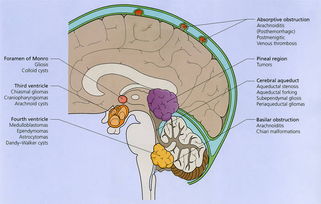 腦水腫觀察的注意事項(xiàng)