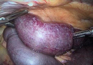 全麻,疝氣,手術后,注意事項