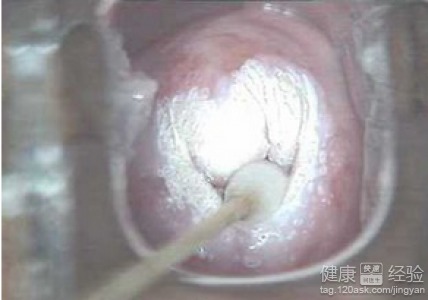 微波治療宮頸糜爛后注意事項(xiàng),宮頸糜爛激光手術(shù)后注意事項(xiàng),宮頸糜爛冷凍治療后注意事項(xiàng)