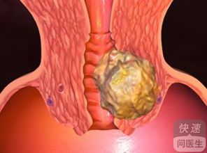 胰腺癌放化療的注意事項,放化療期間注意事項,鼻咽癌放化療后注意事項