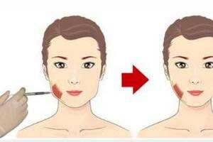 瘦臉針做后注意事項