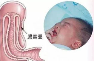 腸梗阻灌腸注意事項