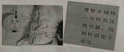 皮下引流管的注意事項