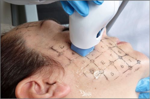 做完塑美極應注意什么,做完酷塑注意事項,做完鉆石超塑的注意事項