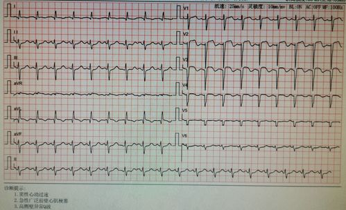 廣泛前壁心梗后注意事項(xiàng)