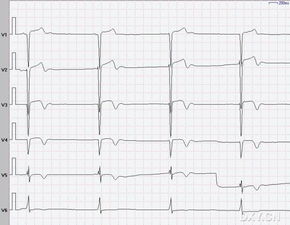 心電圖測(cè)量時(shí)注意事項(xiàng)