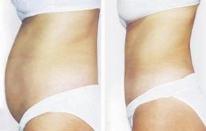 腰腹抽脂后飲食要注意事項(xiàng)
