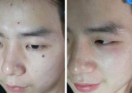 點痣之后注意事項