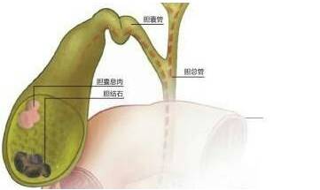 術(shù)前,注意事項,膽囊息肉