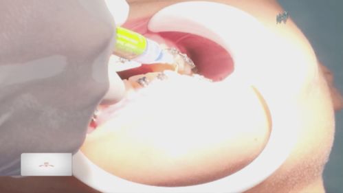 拔牙沒拔牙根注意事項