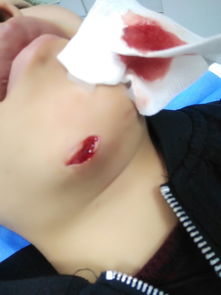 縫美容針后注意事項