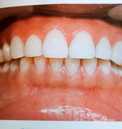 全瓷冠修復的注意事項包括,全瓷冠的臨床注意事項,全瓷冠戴牙注意事項