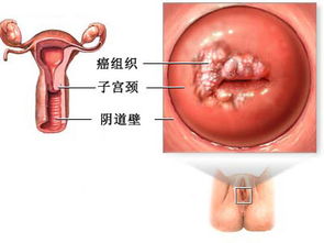 宮頸彩超前注意事項