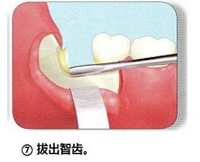 智齒拔牙縫合注意事項(xiàng)